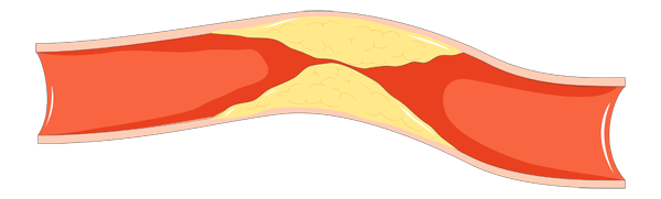 Vernauwing, halsslagader, stenose, ZNA, Vaatheelkunden, Antwerpen