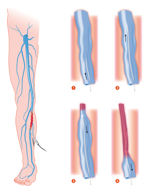 Spataders, varices, ZNA, Vaatheelkunde, ZNA